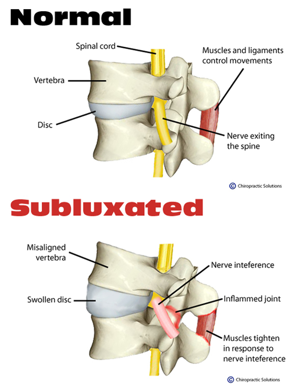 sublaxation